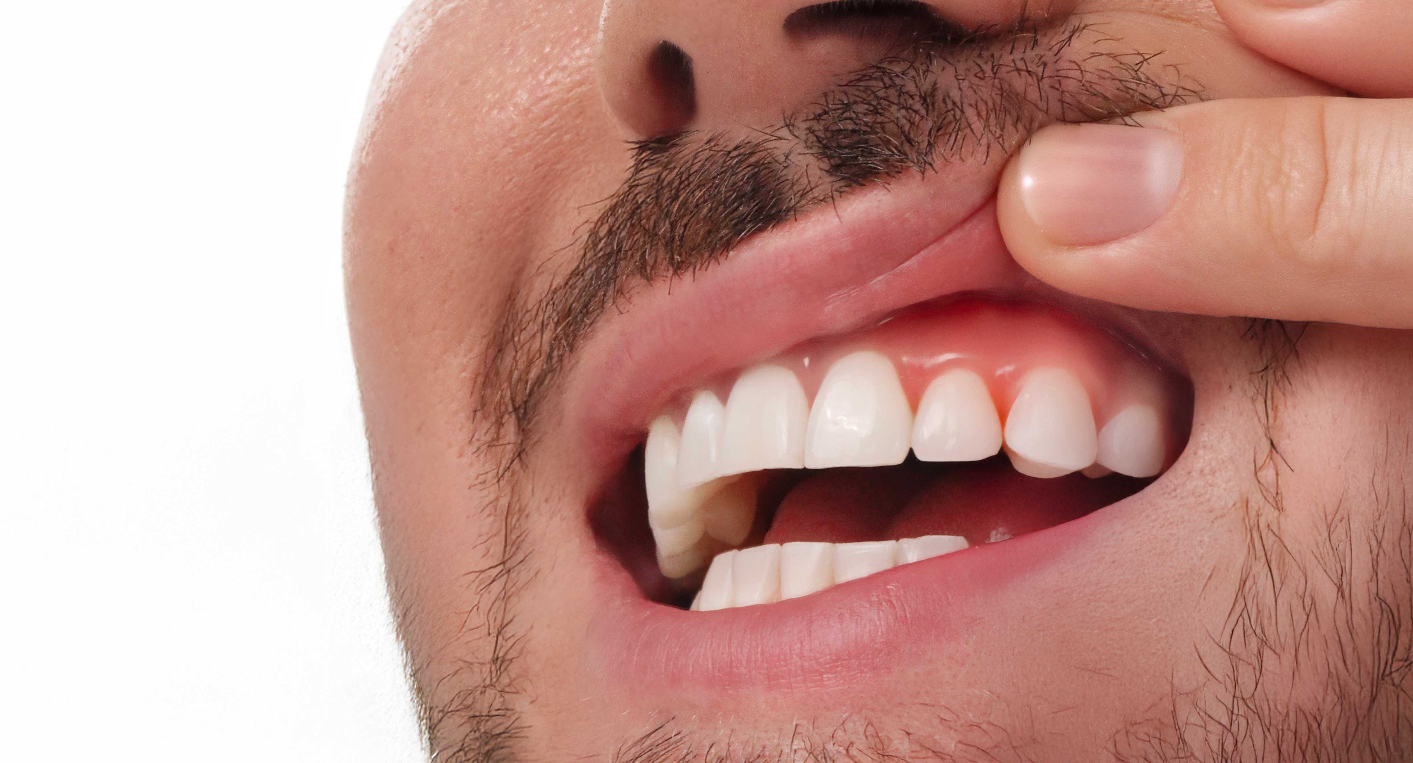 Gingivitis: understand, prevent, treat naturally